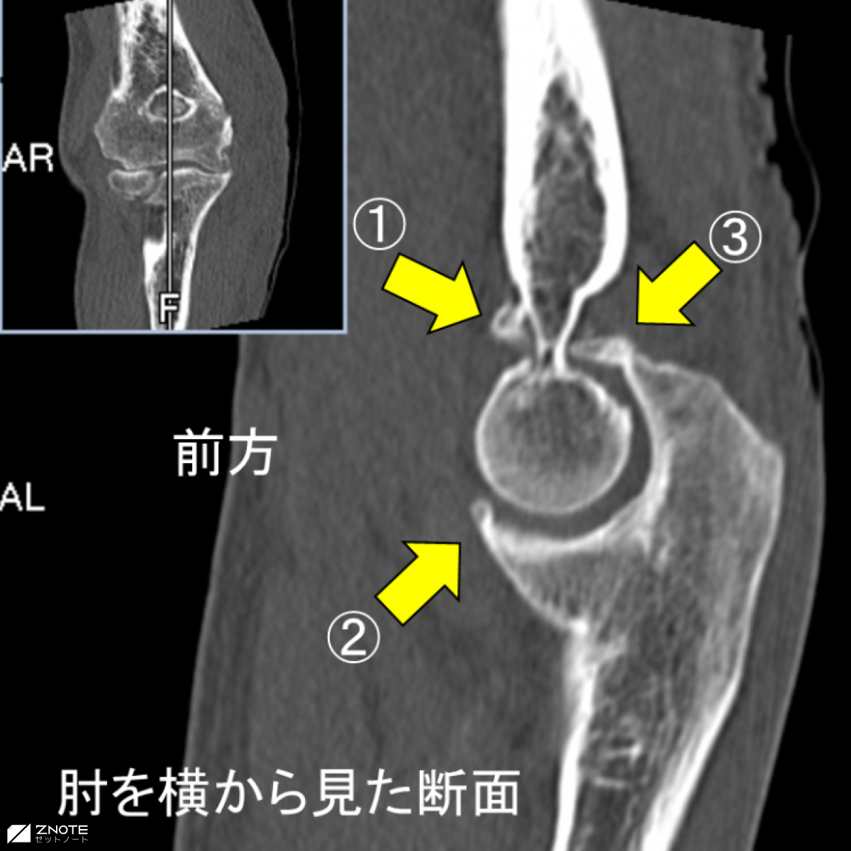 変形性肘関節症 芦澤整形外科