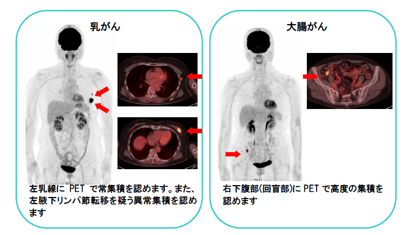 PET-CT検査 | 諏訪赤十字病院